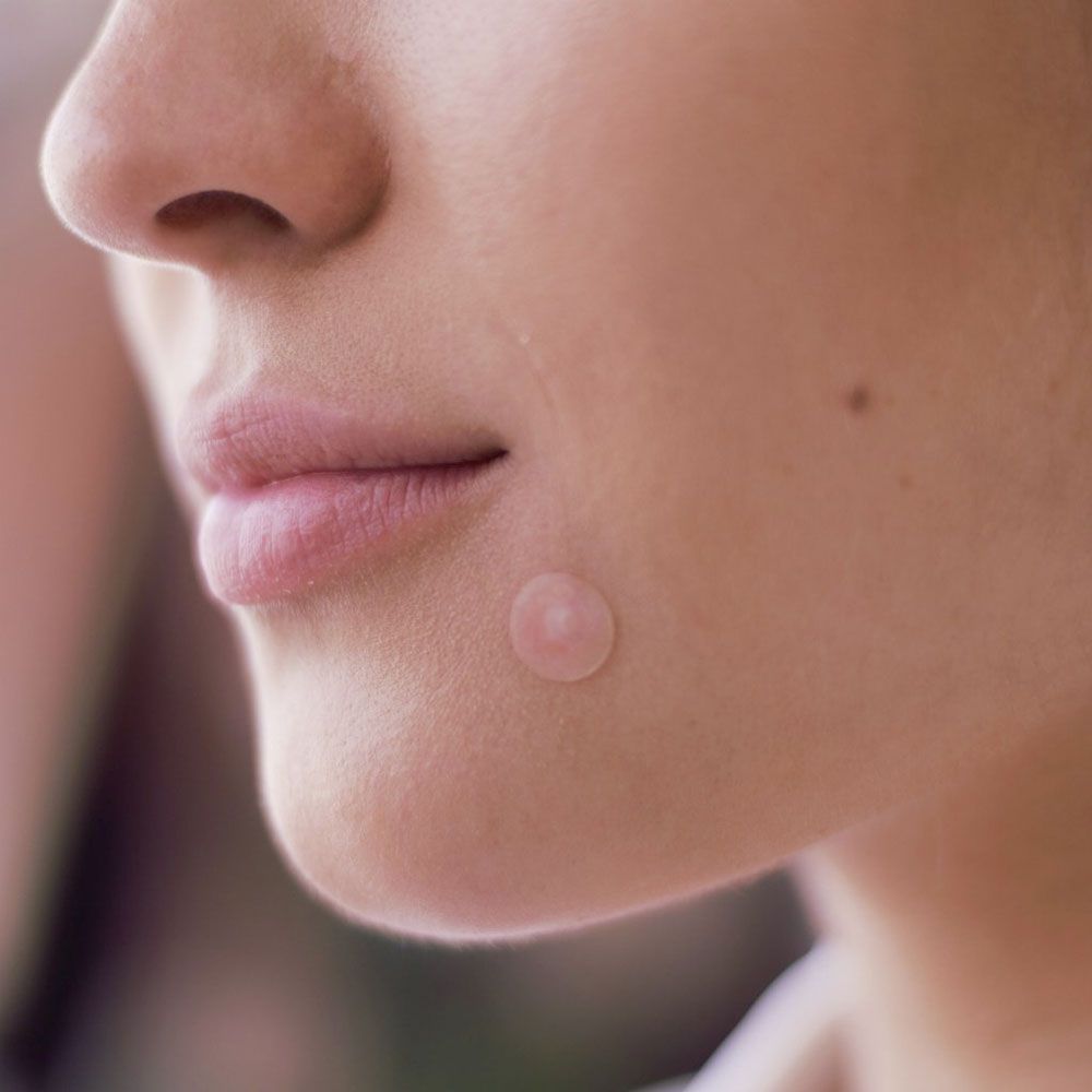 Coony acne fast clear patch - tratamiento para el acné
