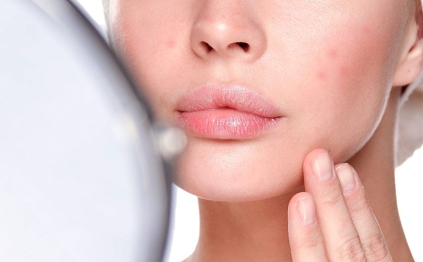 10 tips que debes probar cuando el acné no desaparece